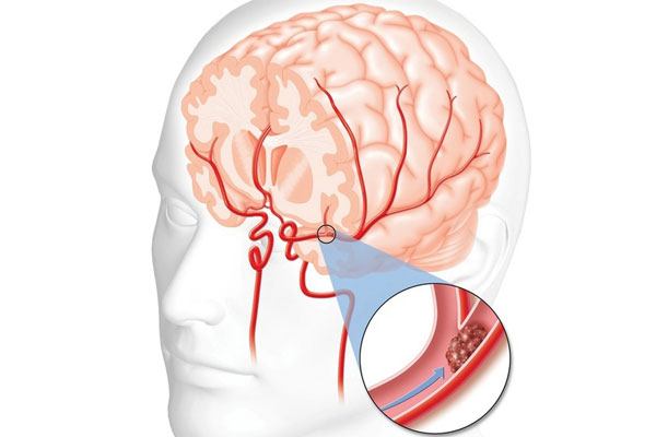 علائم سکته مغزی