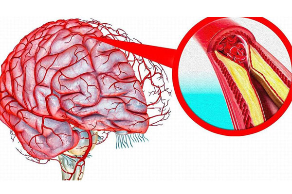 علائم سکته مغزی