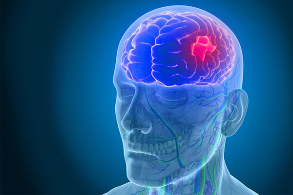 سنگینی زبان بعد از سکته مغزی